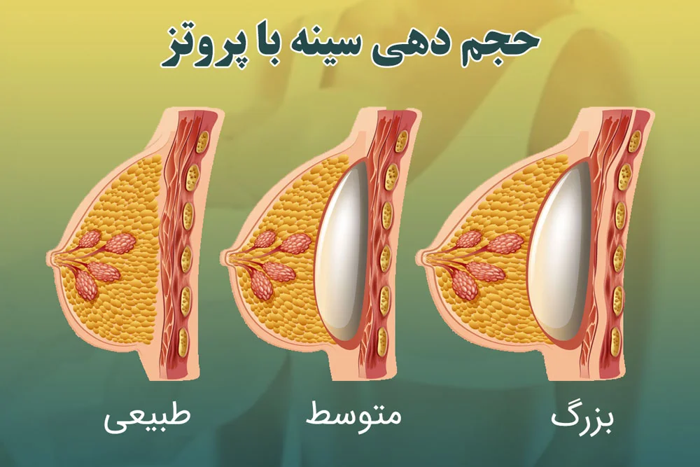 اندازه ایمپلنت سینه