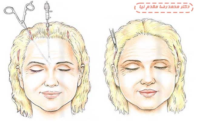 لیفت پیشانی