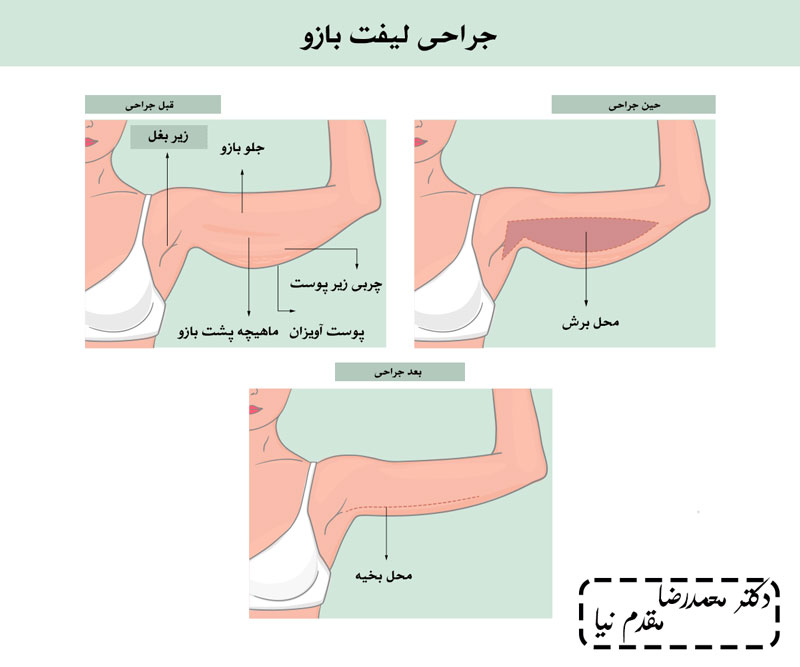 جراحی لیفت بازو