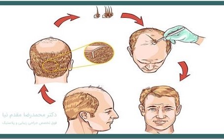 مراحل کاشت مو