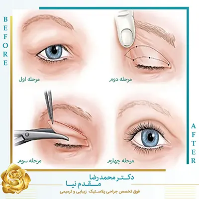 جراحی پلک بالا