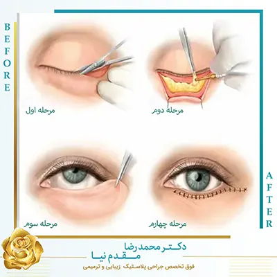 جراحی پلک پایین