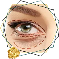 انواع جراحی پلک