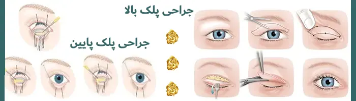 جراحی پلک بالا و پایین