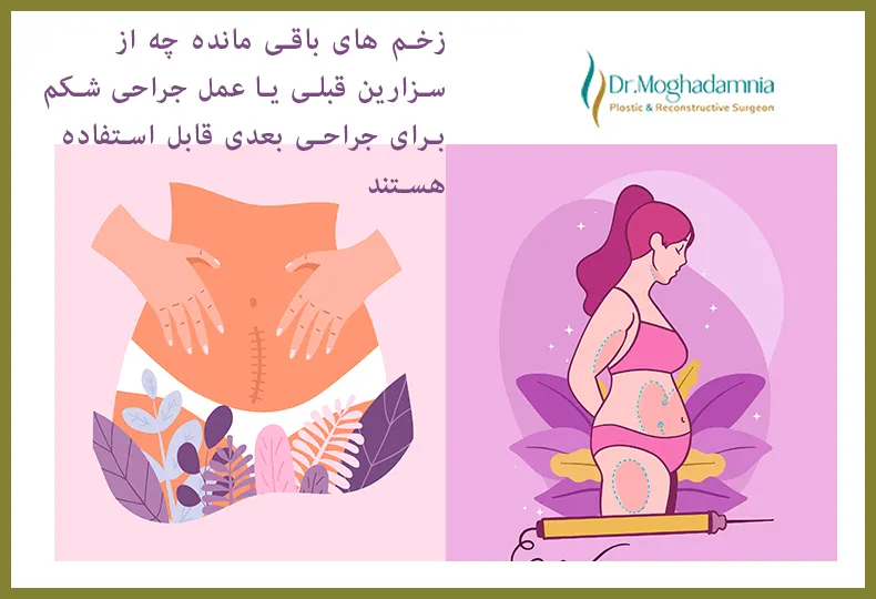 سزارین و ابدومینوپلاستی