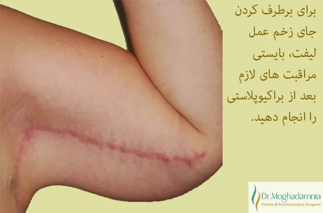 برطرف کردن جای زخم با مراقبت های بعد از عمل لیفت بازو